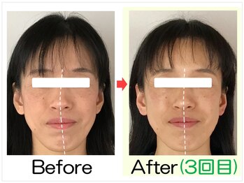 小顔矯正エステ プリュムレーヴ/40代｜左右差が整い美顔に