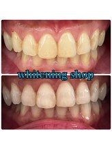 ホワイトニングショップ 三田店/before after