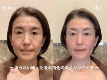 アクア エステティコ 亀有(ACQUA estetico)の雰囲気（シリカマイクロニードルピーリング5回、小顔フェイシャル）