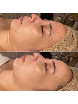 レアリゼ(Realiser)/クリスティーナでたるみ改善!