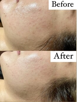 ヴィム(VIM)/ホワイトスノーピール