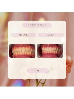 プラスビーセルフ(+b self)/ホワイトニングビフォーアフター