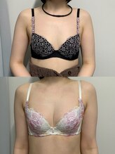 ジュリア(JULIA)/【バストアップ/育乳　症例】