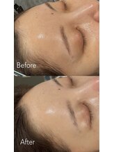 ビオトーン バイ ツリー(biotone by TREE)/フェイシャルワックス/Wax脱毛