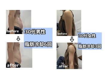 rvコーディネイトサロン(rv coordinate salon)/脂肪冷却の症例です(^^♪