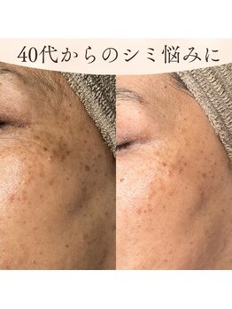 アロマ(AROMA)の写真/ファンデで隠すほど目立つシミ悩みに!光フェイシャルで肌のターンオーバー促進◎明るく透明感ある素肌へ♪