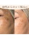 アロマ(AROMA)の写真/ファンデで隠すほど目立つシミ悩みに!光フェイシャルで肌のターンオーバー促進◎明るく透明感ある素肌へ♪