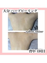 サロンシャイン(Salon Shine)/ハーブピーリング1回