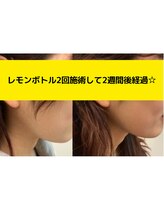 フェリス(feliz)/レモンボトル[小顔/美白/白石区]