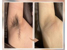 プルベル 平尾(Plus Belle)/脇脱毛