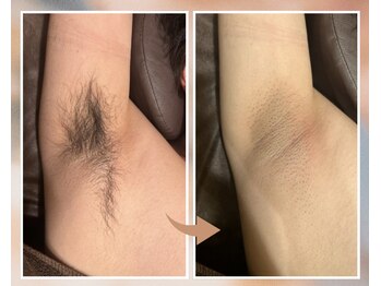 プルベル 平尾(Plus Belle)/脇脱毛