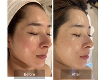 マインエム(mine.m)/vvsダイヤモンドピーリング