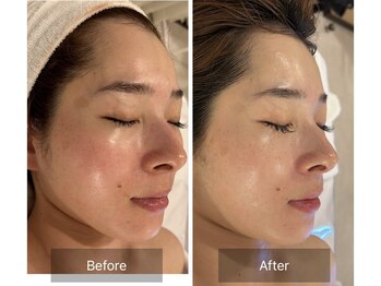 マインエム(mine.m)/vvsダイヤモンドピーリング