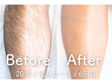 ユング 渋谷店(YUNG)/【足脱毛】剃る習慣から卒業♪