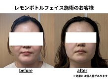 トータルビューティーみつとも/レモンボトル/顔のたるみ/二重顎