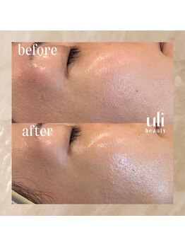 ウリ(uli beauty)/比較写真