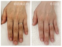 キレイテ 上野店/50代/6回目【上野ハンドケア】