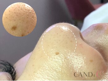 キャンディ 栄店(CANDi)/脂肪燃焼