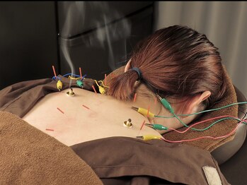 スリープシープ(Sleep Sheep)の写真/手技でアプローチしにくい深層には鍼がオススメ！頑固な首肩こりや慢性疲労を徹底的にケアして納得の効果◎