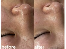 カラン(Calin)/20代お客様☆毛穴汚れ角栓吸引