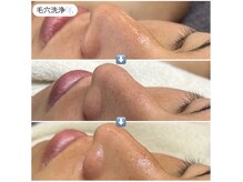 エ リンダ(E- LINDA)/毛穴洗浄