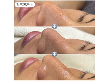 エ リンダ(E- LINDA)/毛穴洗浄