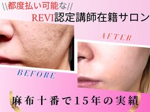 アールスタイルビューティ(R STYLE BEAUTY)の雰囲気（敏感肌もOK◎100％天然素材で肌に負担が少なくダウンタイム無し!）