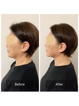 チル(Chill.)/小顔リフト整顔 5