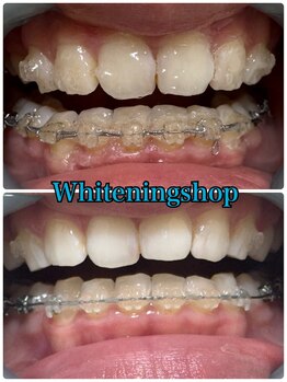 ホワイトニングショップ 山形店(Whiteningshop)/矯正アリでこの白さ