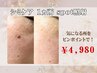 【初回限定】シミケア★スポット照射 お試し★1ヵ所 4,980円