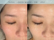 スキンラボアメリ(skin lab. ameri)/お悩み…頬眉間の毛穴 赤み