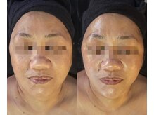 侘寂(wabisabi)/症例写真