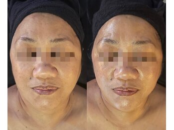 侘寂(wabisabi)/症例写真