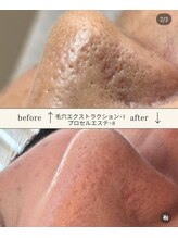 七や美肌/凸凹いちご鼻には正しい毛穴ケア