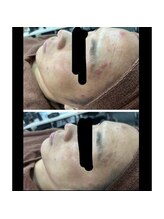 プレイス 天王寺店(PLACE)/ハーブピーリングのお客様です！