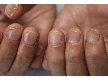 ナンバーアンドスリーサン(No&33)/深爪矯正