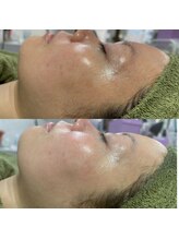 アイラッシュネイルサロン ブリエ(Briller)/スキンケアWAX＋プラズマ
