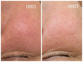 キーオブフェイス(Key of Face)/お悩み【お顔のくすみ・たるみ】