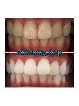 ホワイトニングショップ 大阪玉造店/Before&After美白ホワイトニング