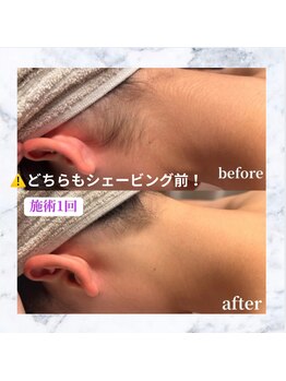 リミー(Reme)/うぶ毛もしっかりキャッチ◎