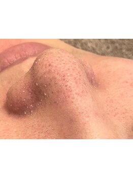 毛穴ケアをしたい