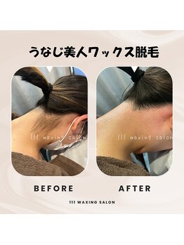 トリプルワン(111)/うなじ脱毛