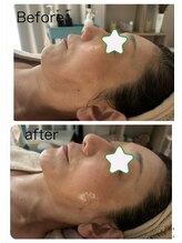 ノレーヴ(NOS REVES)/たるみケア