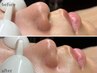 【赤み・乾燥レス】乳酸菌ピーリングアンストレス＋LDM鎮静肌管理60分 