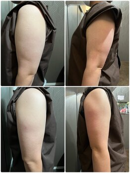 フォーユー整骨院 中島院(foryou整骨院)/二の腕スッキリ☆