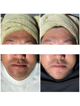 ラクラク(rakuraku)/リフトアップフェイシャル【男】