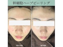 ヘアティブ アンド スキンベイビー 名古屋金山店(Hairtive&Skin Baby)の雰囲気（ヒト幹細胞ハーブフェイシャルで肌トラブル改善！）