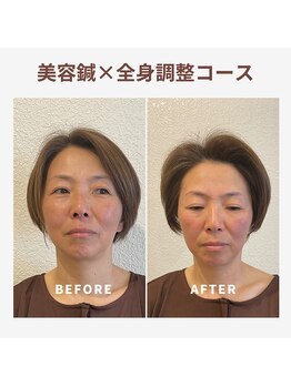 ベルソー鍼灸整体院(berceau鍼灸整体院)/【美容はり×根本改善】