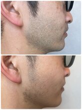 ソウ(SOU)/メンズ　ヒゲ脱毛