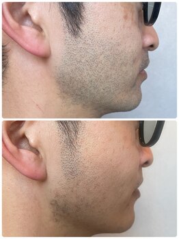 ソウ(SOU)/メンズ　ヒゲ脱毛